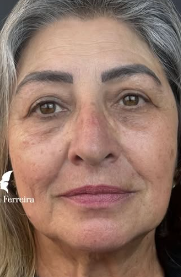 Depois do tratamento 3