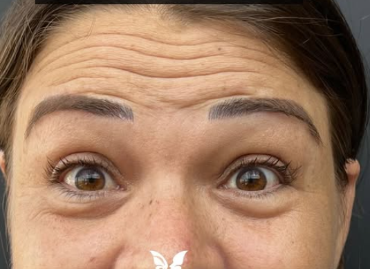 Antes do tratamento 1